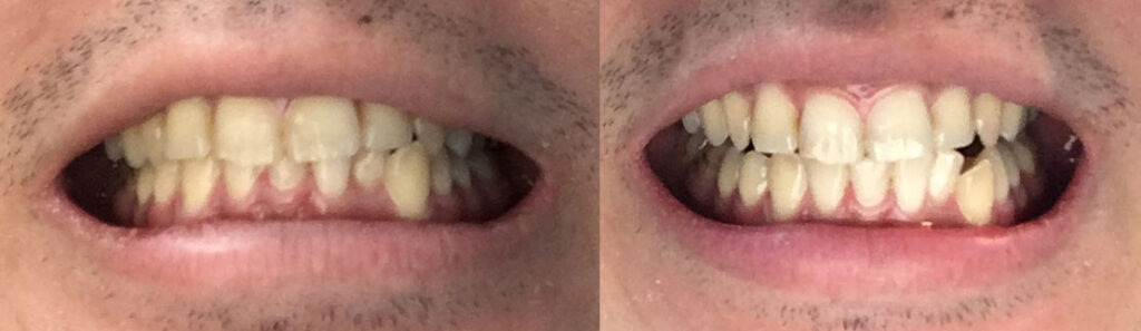 口コミ スノー シャイン スノーシャインの使い方を説明します。ホワイトニングは歯医者に行かなくても大丈夫！